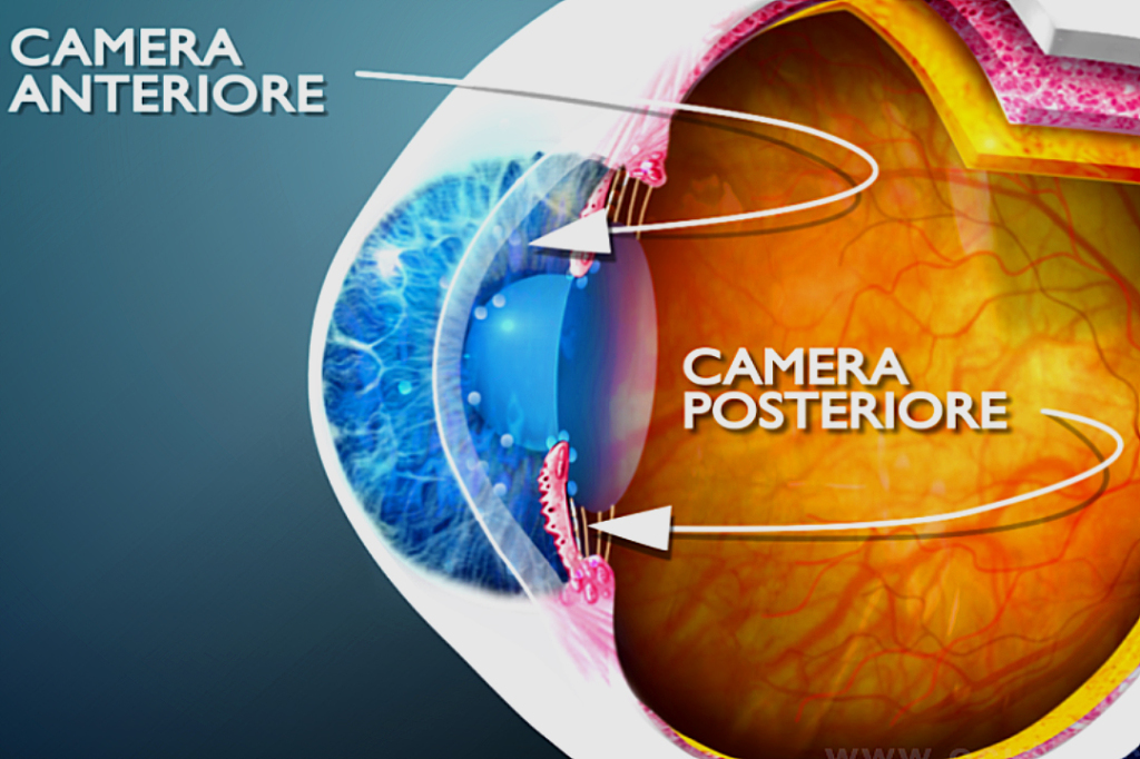 Il glaucoma ad angolo chiuso e l’attacco di glaucoma acuto