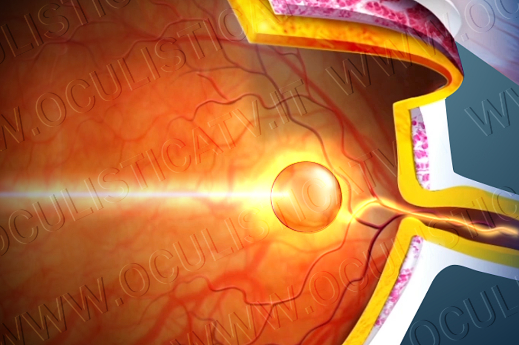 Trattamenti per la retinopatia sierosa centrale